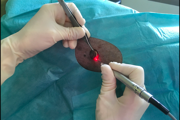 Chirurgie au laser